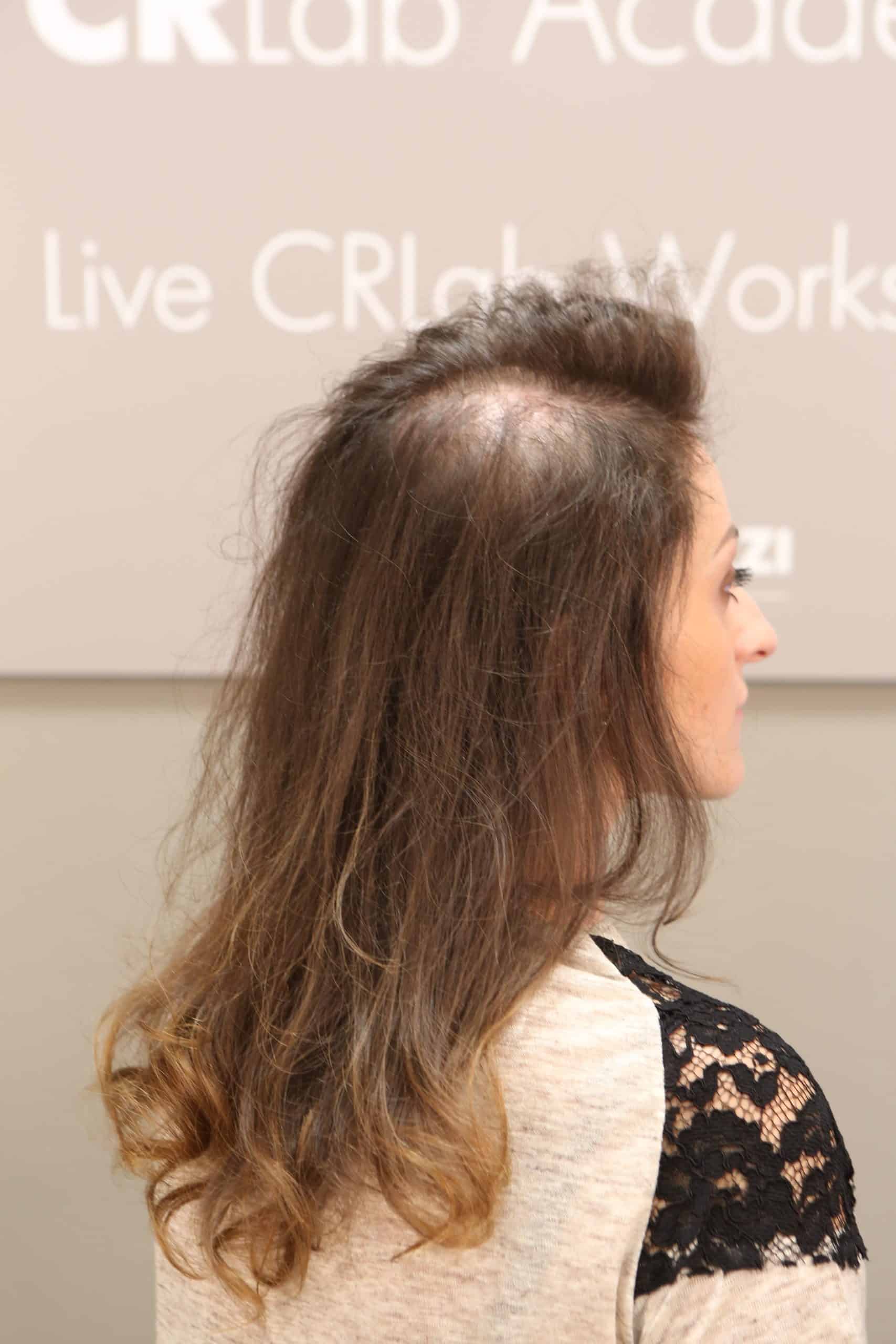 Before - Woman without CNC System & thinning hair | Hair Replacement